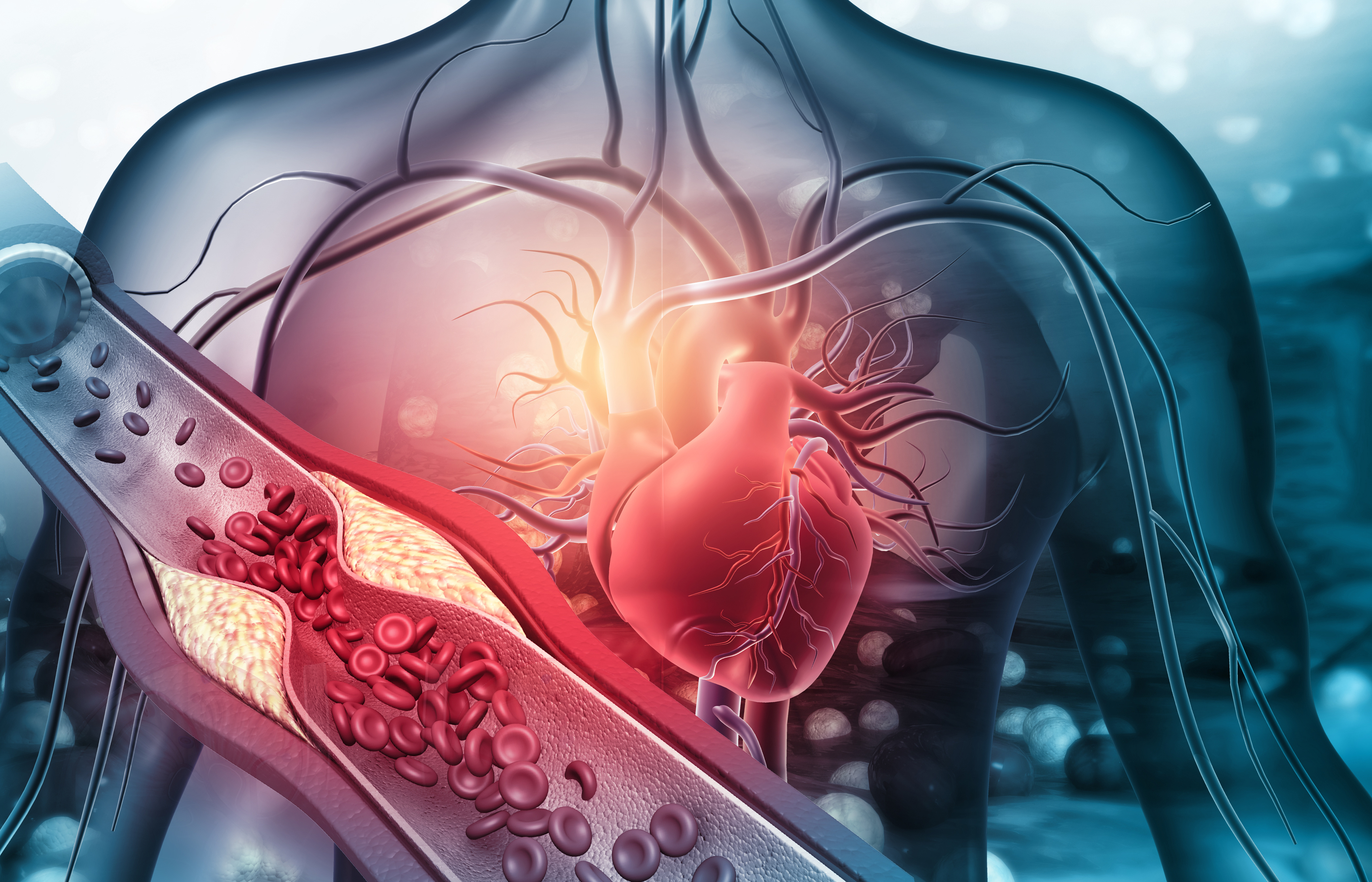 Angioplasty